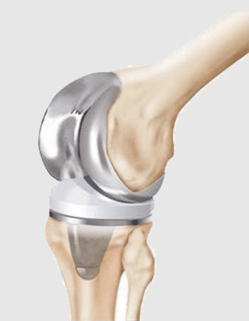  knee Orthopedic